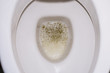 Frothy bubbly urine in the toilet bowl. Kidney disease. Protein. 