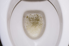Frothy Bubbly Urine In The Toilet Bowl. Kidney Disease. Protein. 