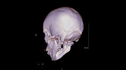 Poster - CT SCAN of Skull or facial Bone in patient trauma case 3d rendering image  Rotating on the screen showing fractured mandible.