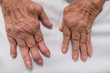 Rheumatoid Arthritis on female hands