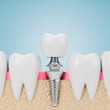 Teeth with implant screw, blue background