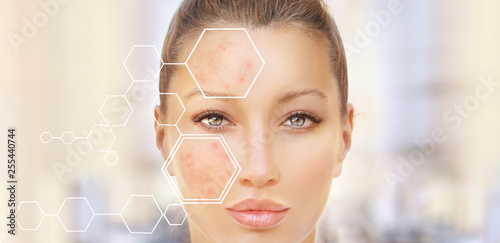 Fotografía Post-Acne Marks /Treating Acne Scars