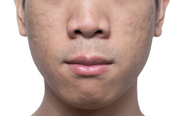 Close-up acne and scars on asian man face, isolated white background