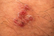 © pinglabel - skin rash and blisters on body (Shingles on men herpes zoster)