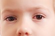 Child conjunctivitis red eye with infection,   health.