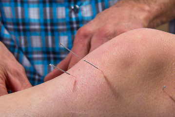 Wall Mural - Dry Needling At The Physical Therapy Clinic - Pain Relief and Healing