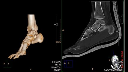 Poster - ct foot or scan of both foot 3d rendering imagecomparison 3d image and 2d sagittal view showing frac