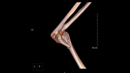 Poster - CT Elbow 3D rendering image showing fracture of distal humerus bone.