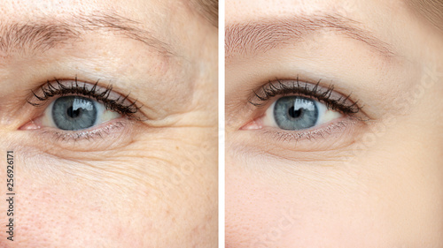 Cuadros en Lienzo Woman face, eye wrinkles before and after treatment - the result of rejuvenating