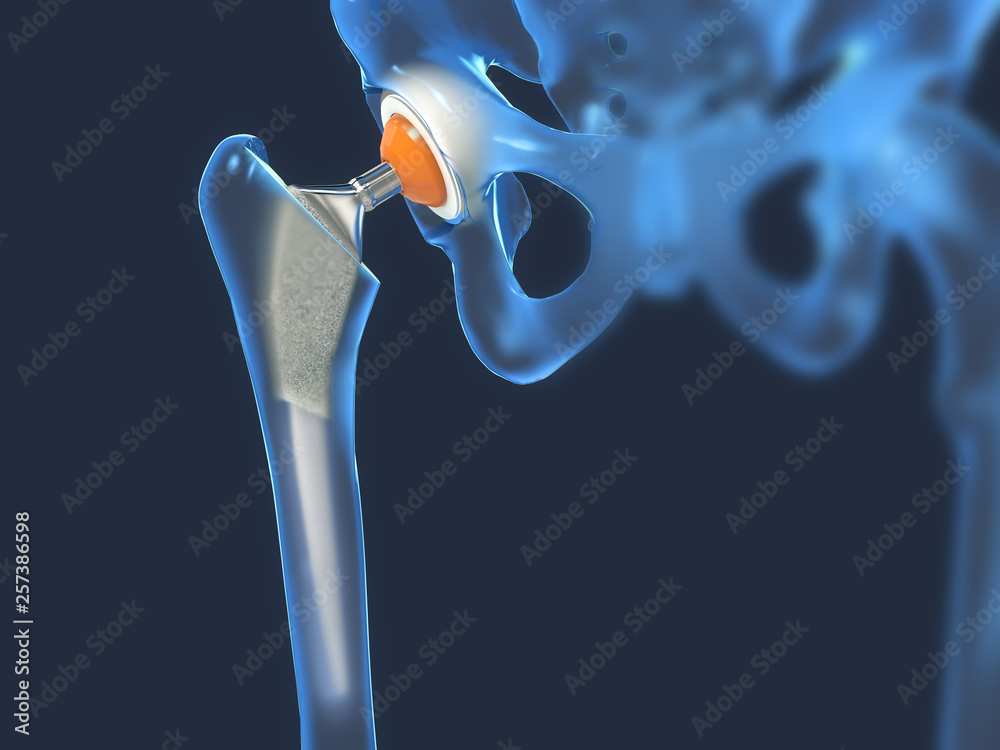 Function of a hip joint implant or hip prosthesis in frontal view - 3d illustration - obrazy, fototapety, plakaty 