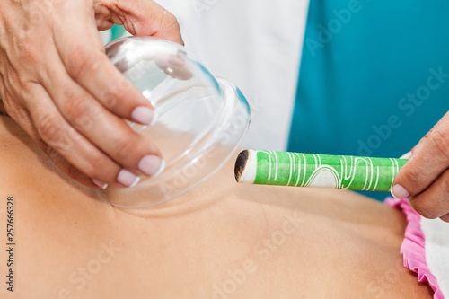 Cuadros en Lienzo Doctor performing a moxibustion therapy on a young female patient back