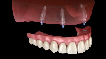 Wall Mural - Maxillary prosthesis All on 4 system supported by implants. Medically accurate 3D animation of human teeth and dentures concept