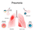 Pneumonia. Difference and Comparison of healthy lungs (bronchioles and alveoli) and pneumonia