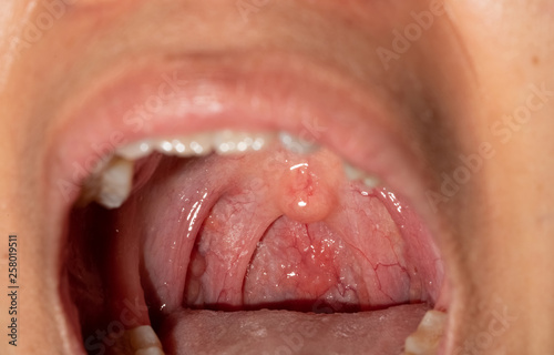Sore throat with throat swollen. Closeup open mouth with posterior pharyngeal wall swelling and uvula and tonsil. Influenza follicles in the posterior pharyngeal wall. Upper respiratory tract. - Buy this stock photo Sore throat with throat swollen. Closeup open mouth with posterior pharyngeal wall swelling and uvula and tonsil. Influenza follicles in the posterior pharyngeal wall. Upper respiratory tract. - Buy this stock photo