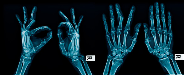 Wall Mural - x-ray image hand and finger