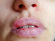 © galitsin - Beautiful female lips cracked from frost, wind, lack of vitamins. Sore from herpes virus. Lips need hygiene