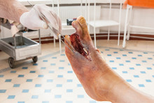 Foot,treating Patients With Foot Ulcers,Diabetic Foot Ulcer. Amputation Of Figers
