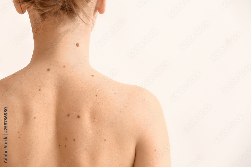 Young Woman With Moles On White Background Stock Gamesageddon gamesageddon