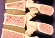 Model of spine showing porous bone marrow in case of osteoporosis