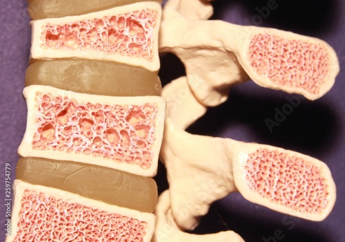 Cuadros en Lienzo Model of spine showing porous bone marrow in case of osteoporosis