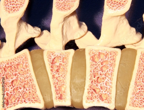 Fotografía Model of spine showing porous bone marrow in case of osteoporosis