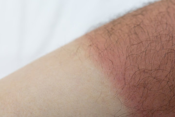 Sunburn and normal skin on the male foot