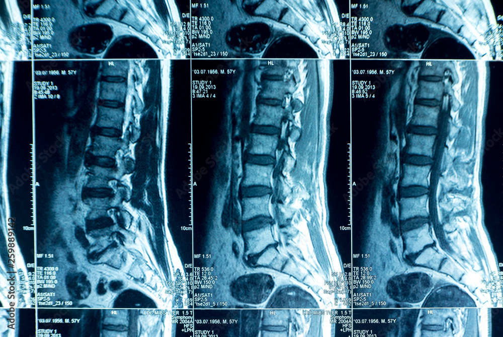 MRI scans of the lumbosacral spine Stock Photo | Adobe Stock