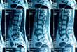 © Elena Abduramanova - MRI scans of the lumbosacral spine