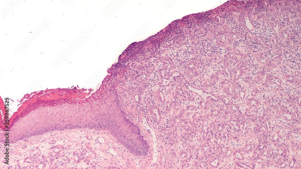 Photomicrograph of a pyogenic granuloma, showing a lobular pattern of ...