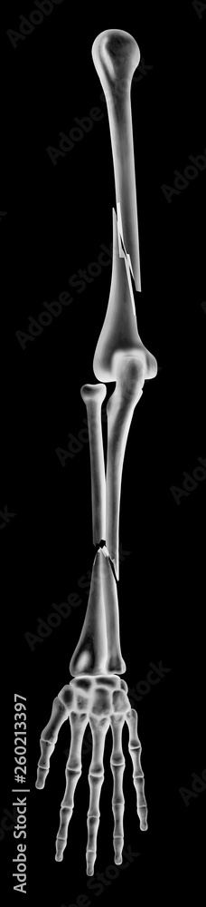 X-ray of ulna- radius and humerus or broken arms completed displaced ...