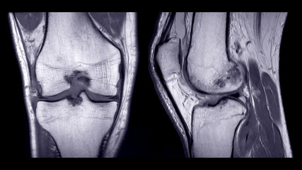Poster - magnetic resonance imaging or mri of right knee comparison coronal and sagittal view.
