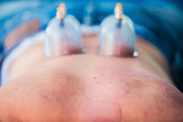 The back of the man with blood marks by cupping treatment,Cupping therapy marks on the back,Chinese treatment