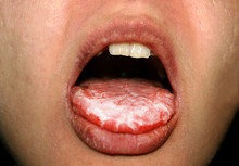 Thrush In The Tongue Of The Child. Candida