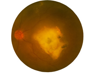 Retina of diabetes , diabates retinopathy,photo Medical Retina Abnormal isolated on white background.Saved with clipping path