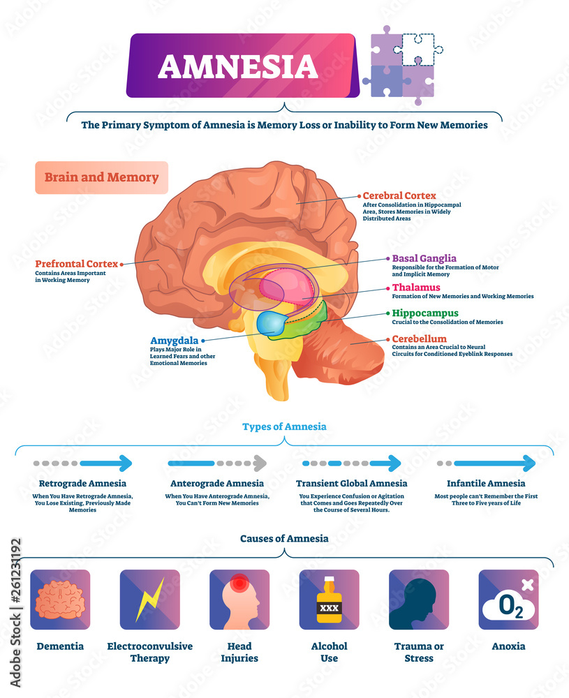 Amnesia vector illustration. Labeled brain memory loss disease types ...
