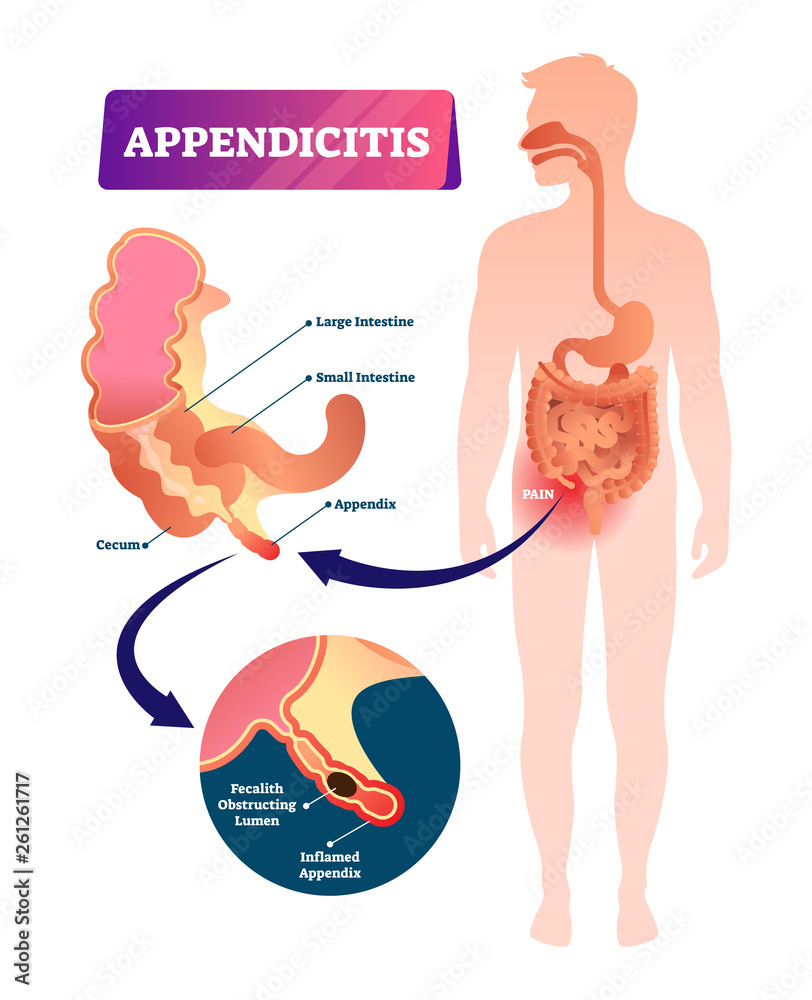Appendicitis vector illustration. Labeled appendix inflammation pain ...