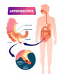 Appendicitis vector illustration. Labeled appendix inflammation pain scheme