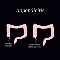 Wall Mural - Appendicitis. Inflammation of the appendix. Colon. The illustration on a black background