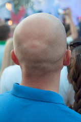 Nape of a bald middle-aged man in a blue t-shirt in the city. Rear view of bald man.  The problem of age baldness