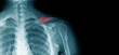 x-ray clavicle fracture, accident of old man at shoulder part