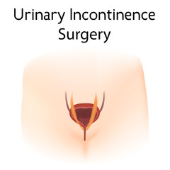 Anatomy picture of Urinary incontinence surgery. Realistic medical illustration. Woman body silhoutte.