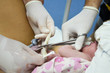 Cutting the umbilical cord between a newborn baby and placenta.