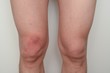 A front view of knee bruising which has been caused by unnoticed bumping. A common side effect of aspirin intake.