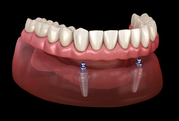 Mandibular removable prosthesis All on 2 system supported by implants with ball attachments. Medically accurate dental 3D illustration