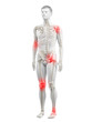 © Sebastian Kaulitzki - 3d rendered medically accurate illustration of a mans painful joints