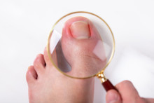 Person Holding Magnifying Glass Over Sore Toe Nail