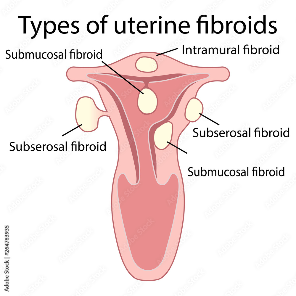 Medical Management of Fibroids | PPTX, image size:1000x1000