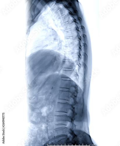 X Ray Image Of T L Spine Or Thoracolumbar Spine Lateral View For Diagnosis Back Pain Buy This Stock Photo And Explore Similar Images At Adobe Stock Adobe Stock X Ray Image Of T L Spine Or Thoracolumbar Spine Lateral View For Diagnosis Back Pain Buy This Stock Photo And Explore Similar Images At Adobe Stock Adobe Stock