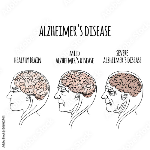 Dementia Alzheimer Disease Memory Loss Brain Damage Medicine