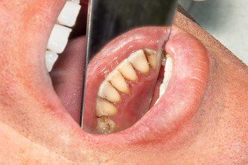 Wall Mural - human teeth with smoking plaque and tartar. Close-up macro in dental clinic. Hygiene concept
